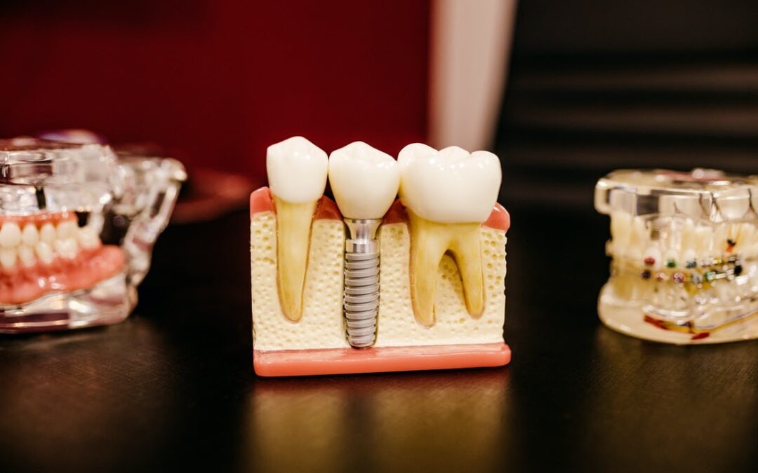 Cosmetic Dentistry Procedures 1: Why Dental Implants?