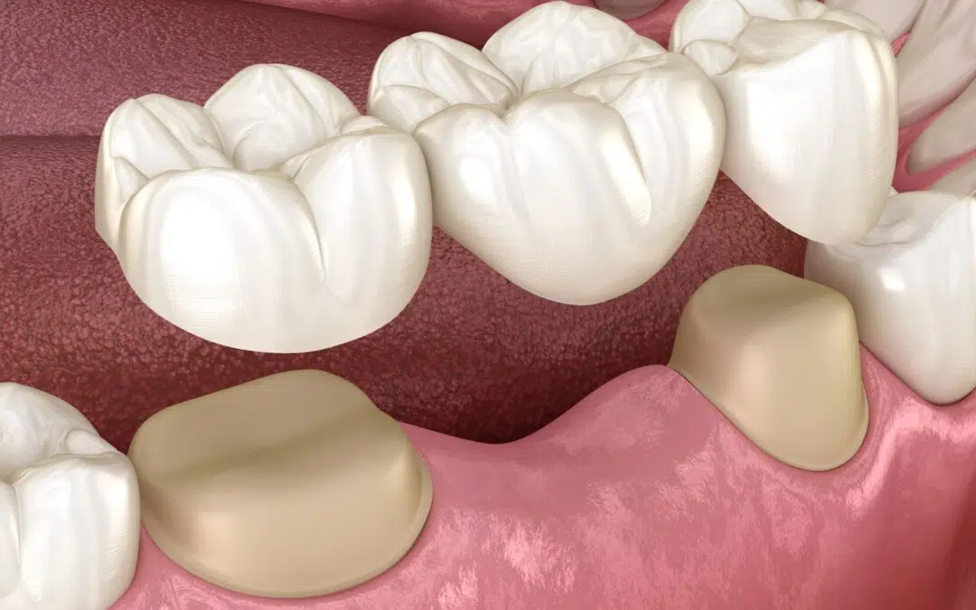 Cosmetic Dentistry Procedures 3: How Do Dental Bridges Work