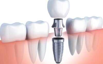 Dental Implants: A Solution to Your Missing Teeth