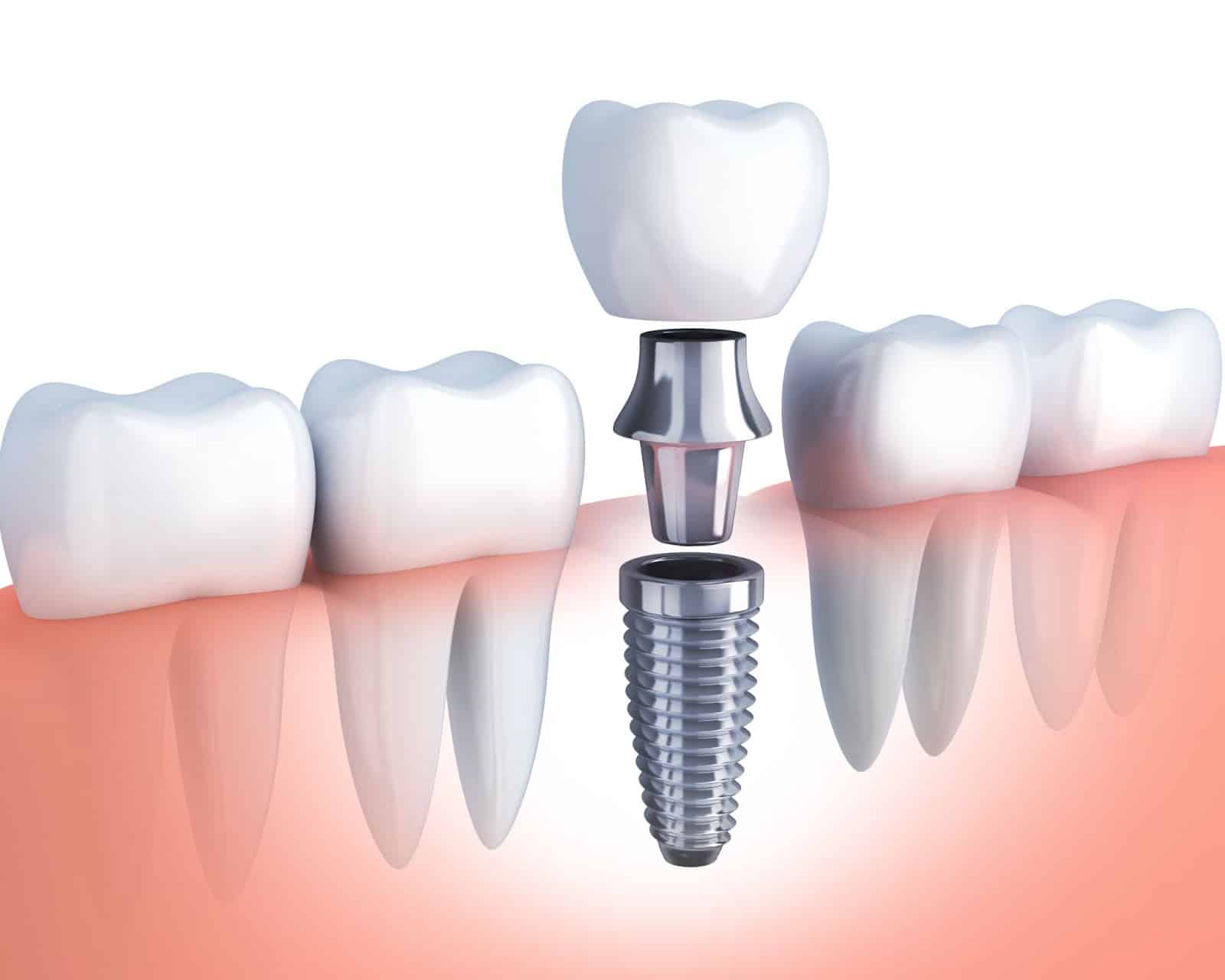 Dental Implants A Solution to Your Missing Teeth