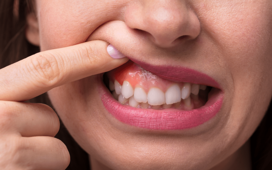 Understand Gingivitis: Causes, Symptoms, and Treatment Options