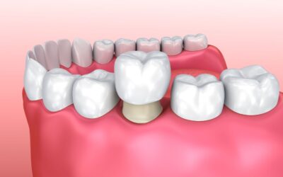 How Does A Dental Crown Work?