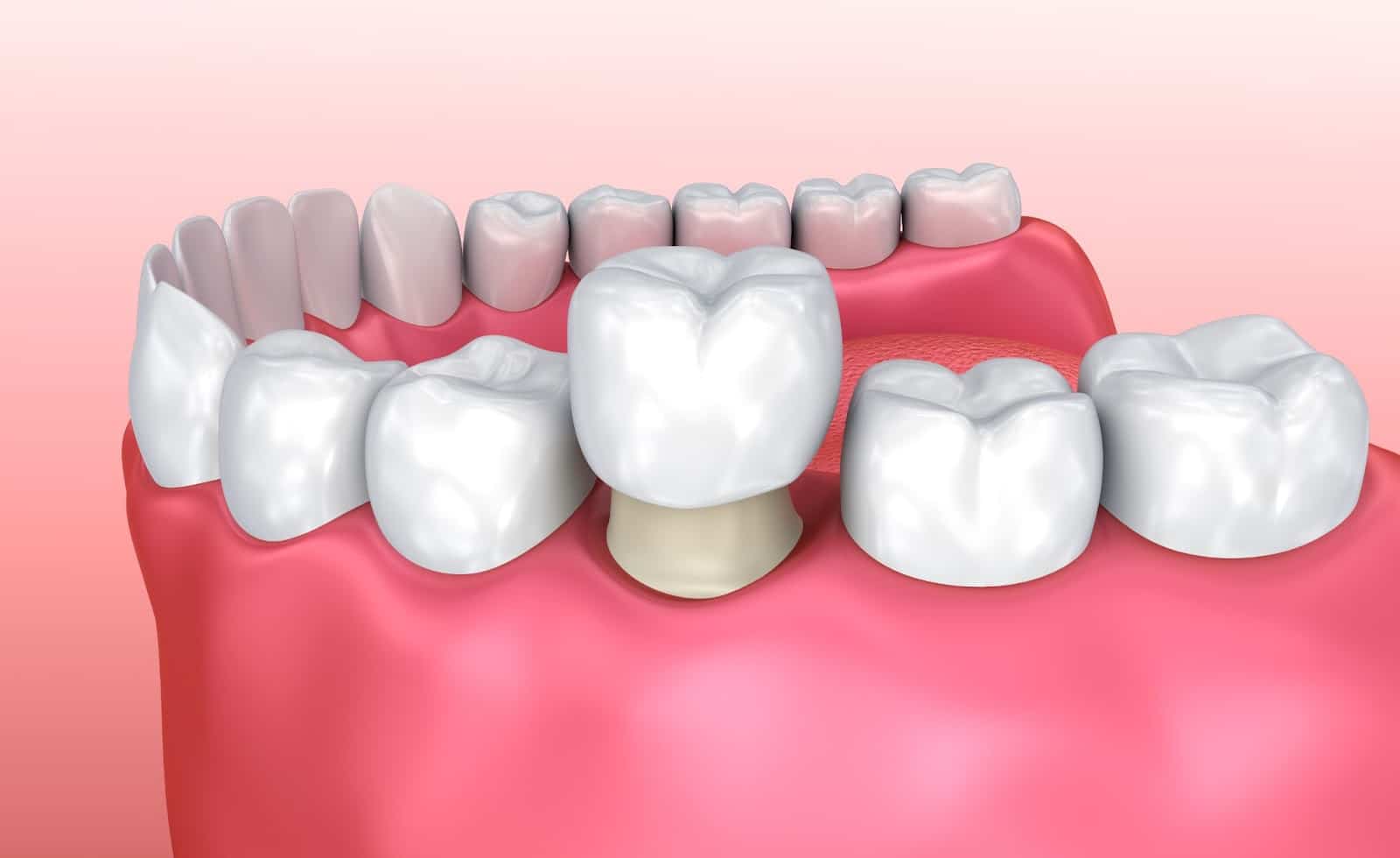 How Does a Dental Crown Work