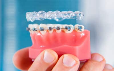 Invisalign vs Braces: Which One is Right for You?