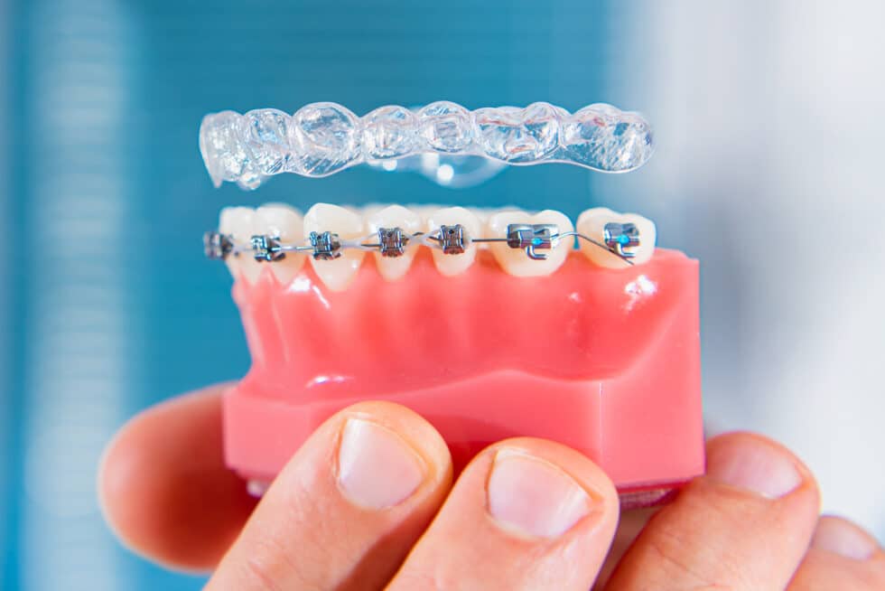 Invisalign vs Braces Which One is Right for You?