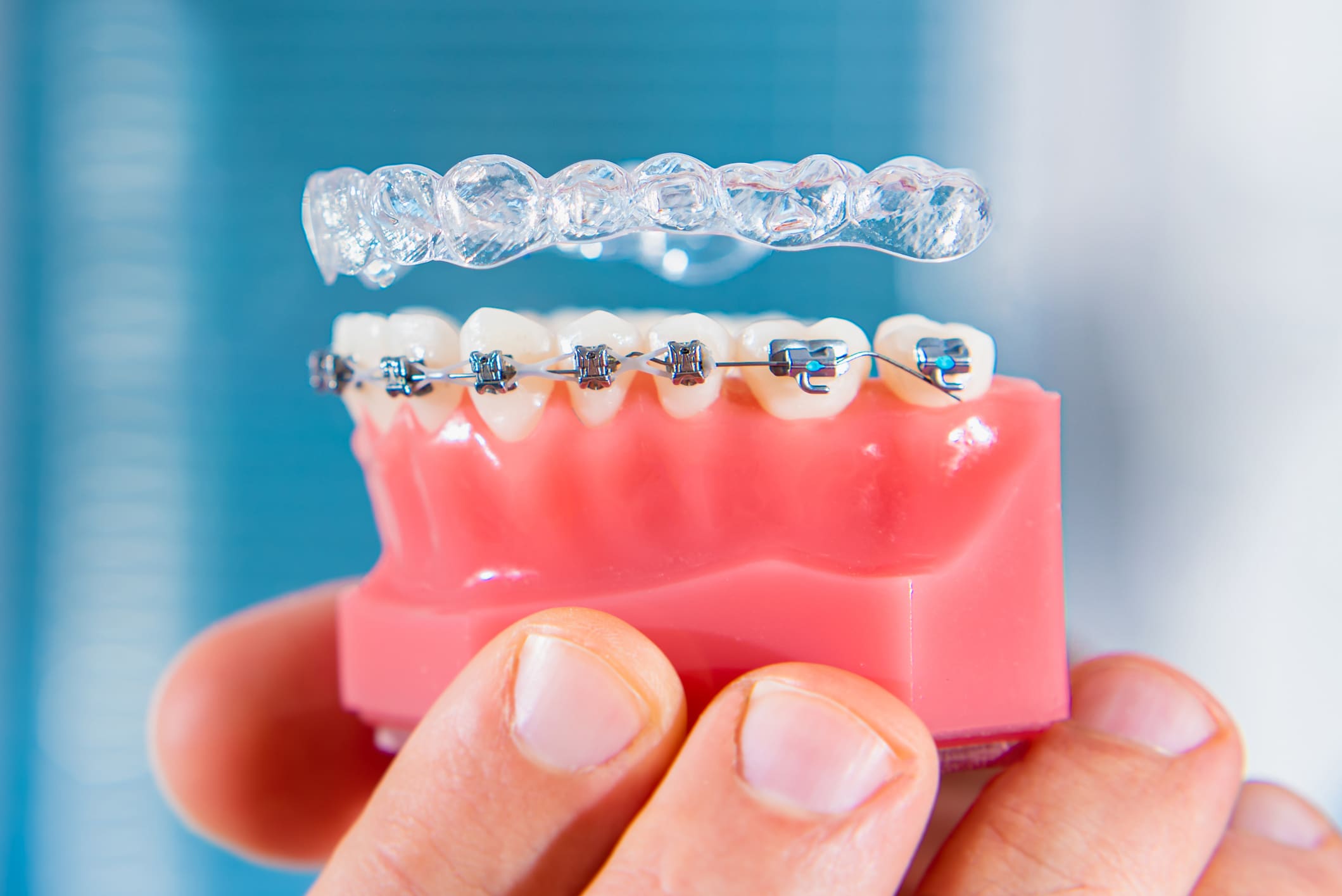 Invisalign vs Braces: Which One is Right for You?