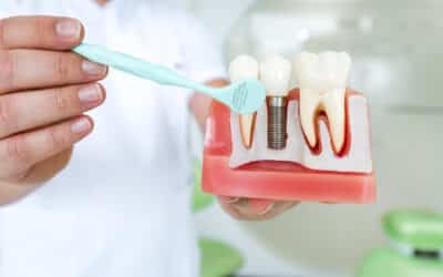 Dental Implants vs Bridges: Which One is Right for You?