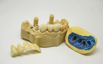 The Different Types of Dental Crowns and Their Benefits