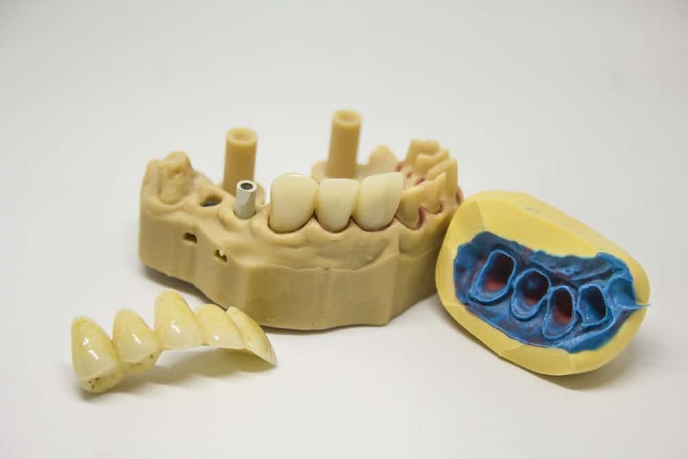 The Different Types of Dental Crowns and Their Benefits