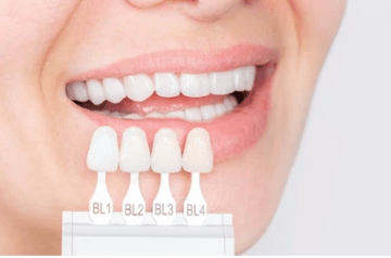 Types of Dental Veneers You Should Know About