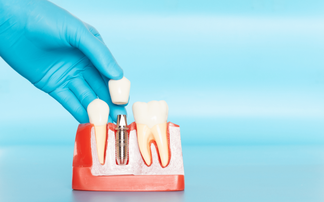 Closing the Gap – 3 Options for Replacing a Missing Tooth