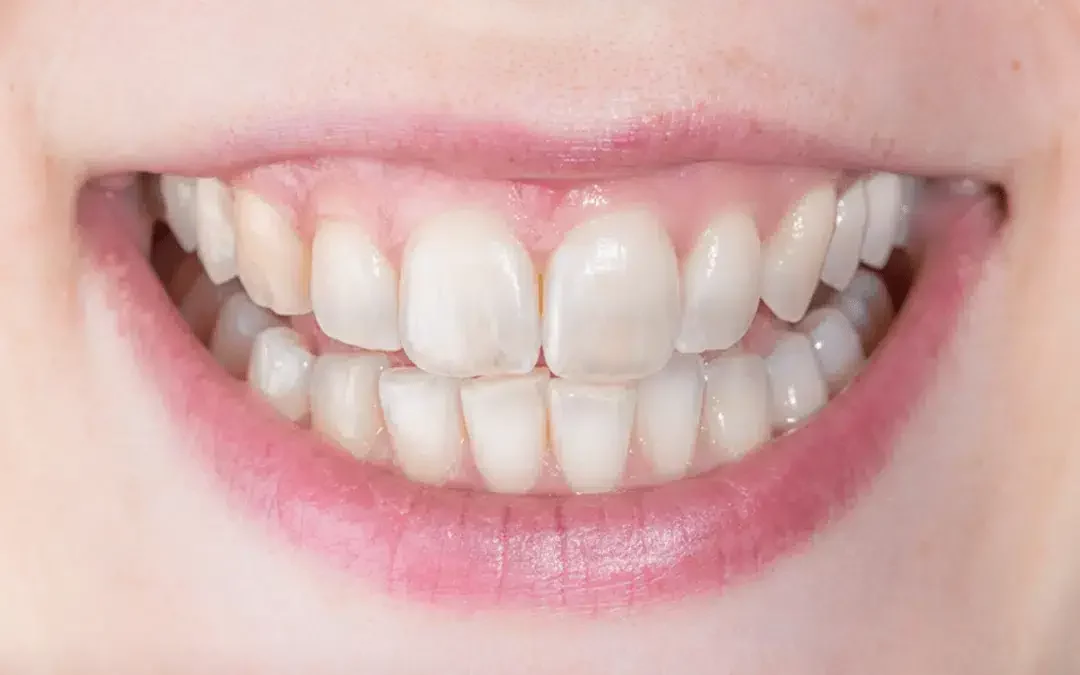 Are Translucent Teeth a Sign of Bad Oral Health?