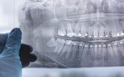 Why Do You Need A Dental Exam Before Getting Your Wisdom Teeth Removed?