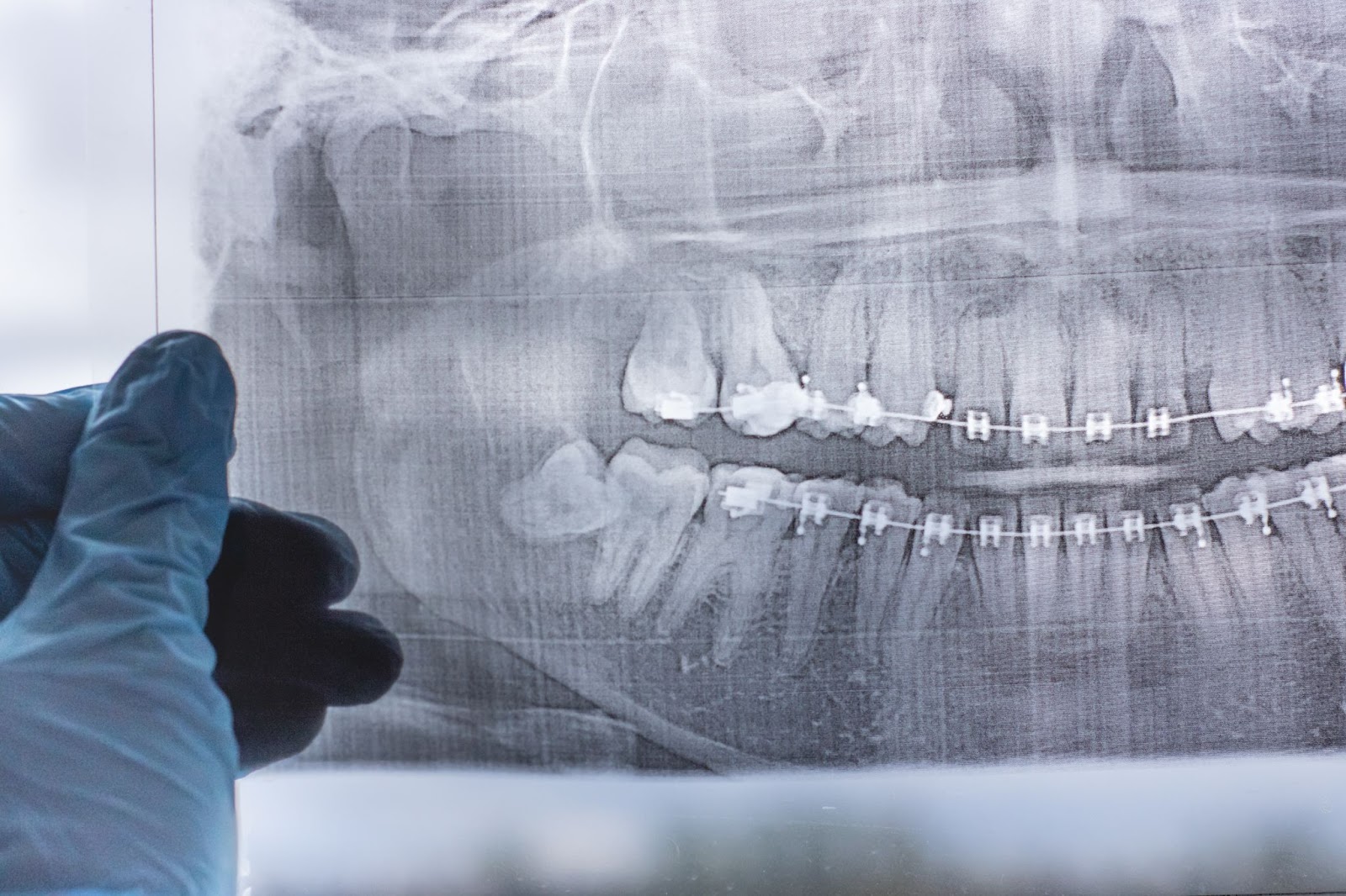 why-do-you-need-a-dental-exam-before-getting-your-wisdom-teeth-removed